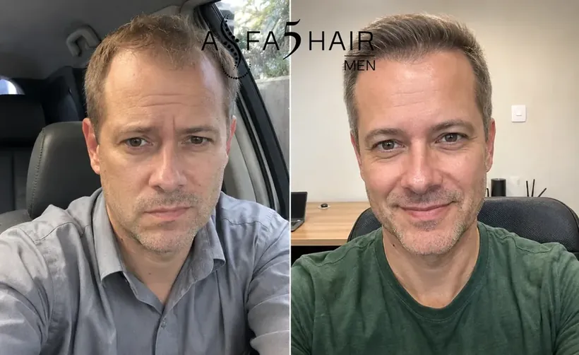 Antes e depois Alfa5Hair
