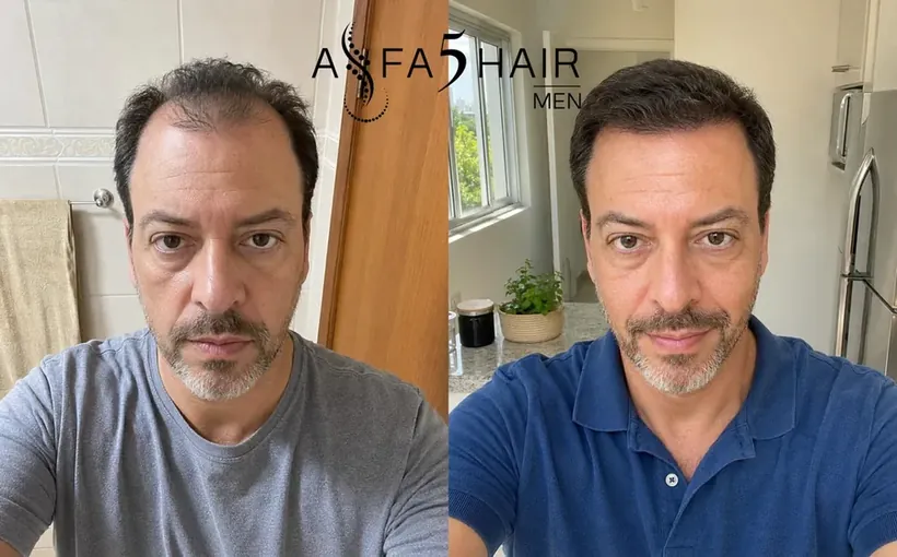 Antes e depois Alfa5Hair