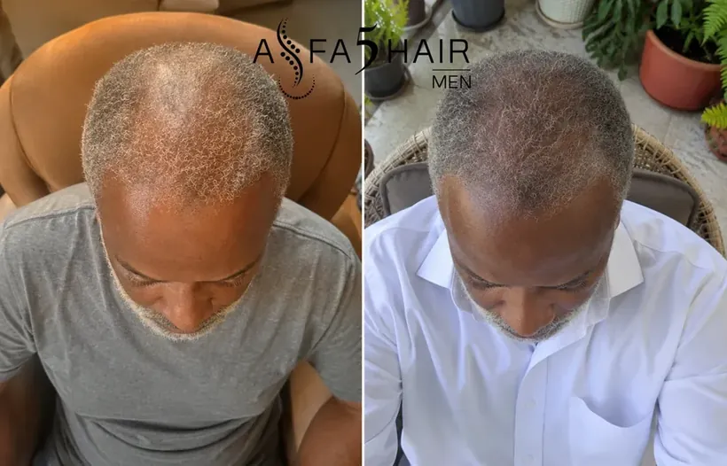 Antes e depois Alfa5Hair