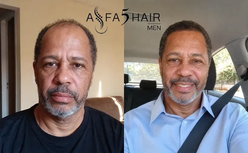 Antes e depois Alfa5Hair