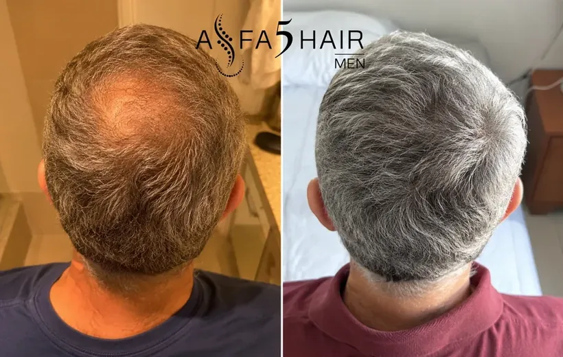 Antes e depois Alfa5Hair