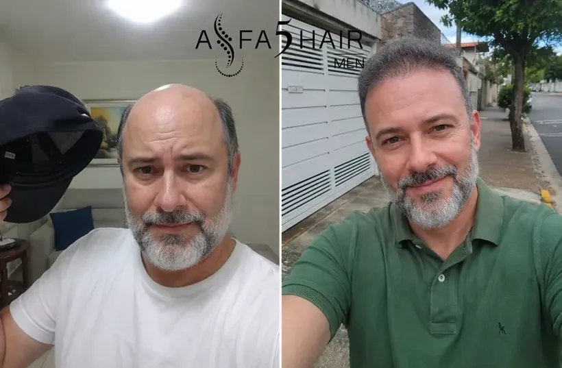 Antes e depois Alfa5Hair