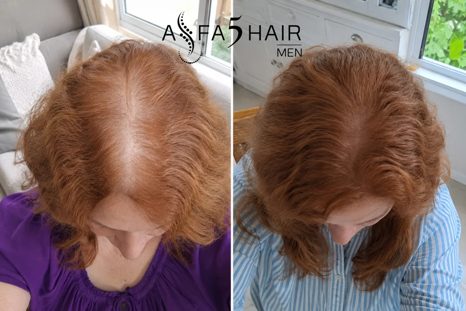 Antes e depois Alfa5Hair