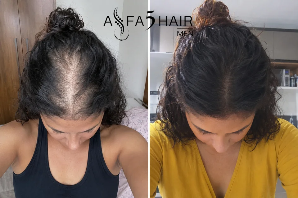 Antes e depois Alfa5Hair