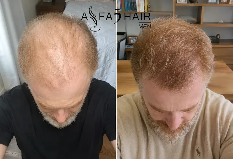 Antes e depois Alfa5Hair