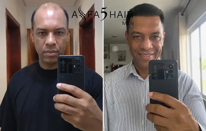 Antes e depois Alfa5Hair