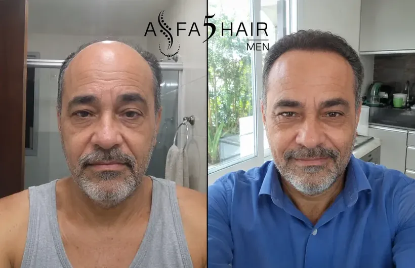Antes e depois Alfa5Hair