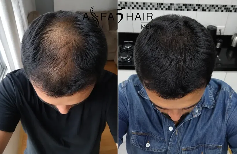 Antes e depois Alfa5Hair